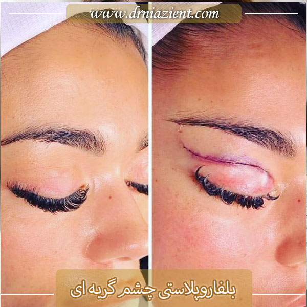 بلفاروپلاستی چشم گربه ای - دکتر معصومه نیازی