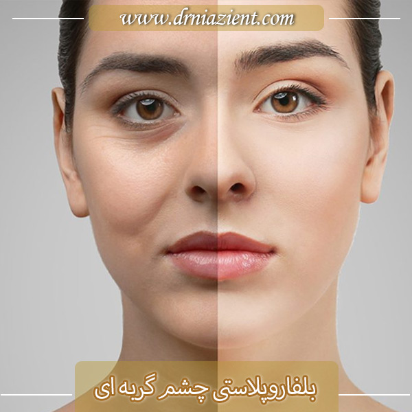 بلفاروپلاستی چشم گربه ای - دکتر معصومه نیازی