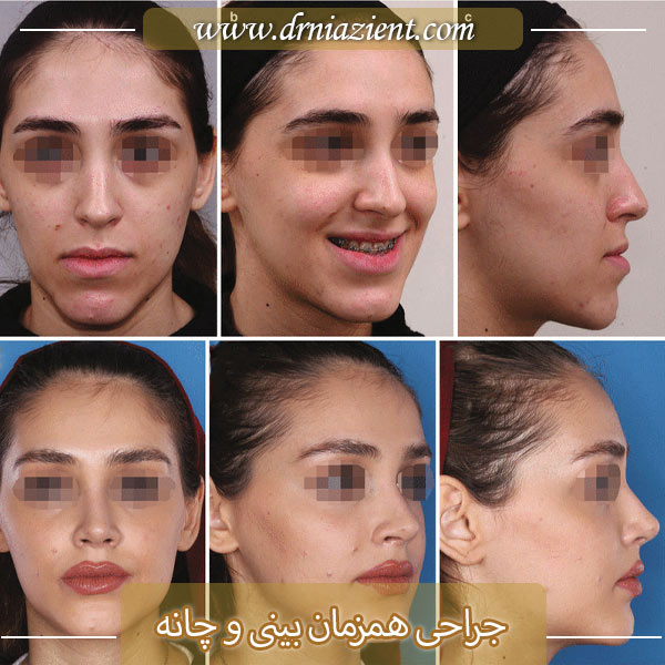 جراحی همزمان بینی و چانه - دکتر نیازی