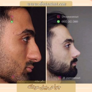 جراحی بینی مردانه - دکتر معصومه نیازی