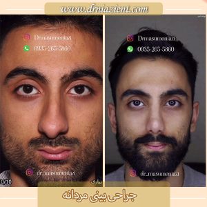 جراحی بینی آقایان - دکتر نیازی