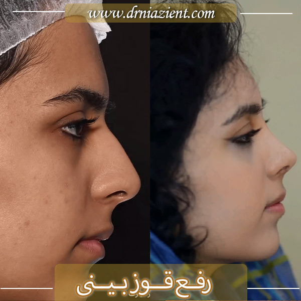 رفع قوز بینی - دکتر نیازی