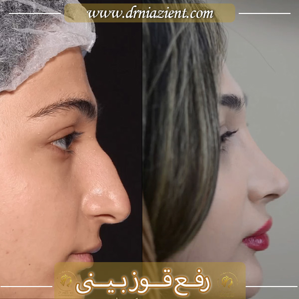 اصلاح و رفح قوز بینی - دکتر معصومه نیازی