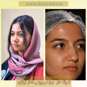 نمونه کار بهترین جراح بینی کرج - دکتر معصومه نیازی