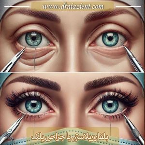 جراحی پلک - دکتر نیازی