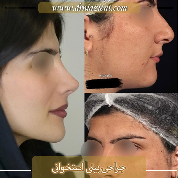 عمل بینی استخوانی در کرج  - دکتر معصومه نیازی
