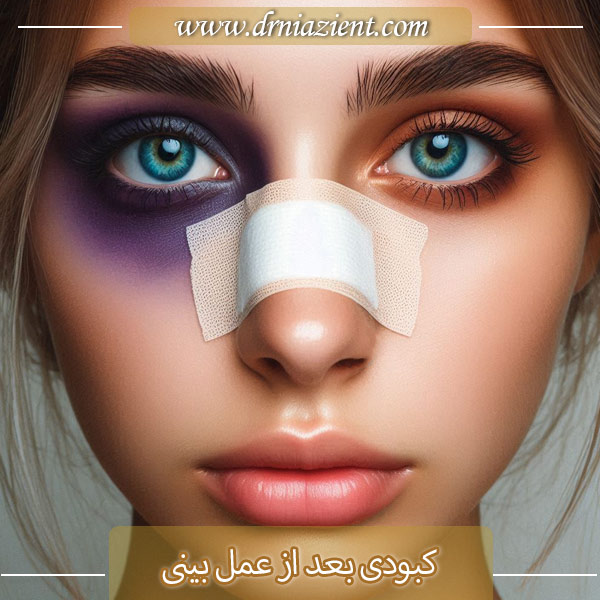 کبودی بعد از عمل بینی | دکتر معصومه نیازی