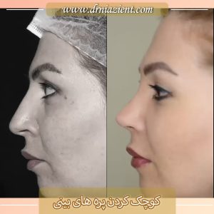 کوچک کردن پره های بینی - دکتر معصومه نیازی 