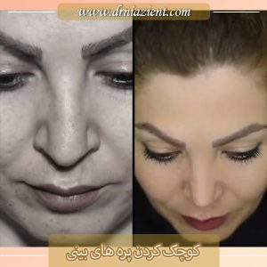 کوچک کردن پره های بینی - دکتر معصومه نیازی 