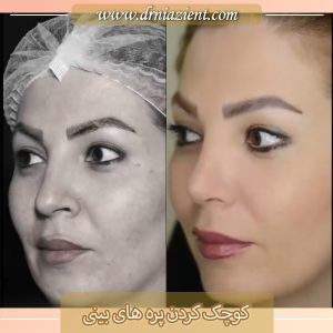 کوچک کردن پره های بینی - دکتر معصومه نیازی 