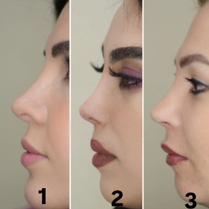 انواع بینی عمل شده - دکتر معصومه نیازی