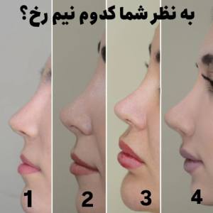 انواع بینی عمل شده - دکتر معصومه نیازی