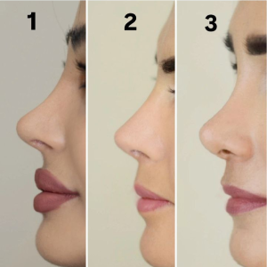 انواع بینی عمل شده - دکتر معصومه نیازی