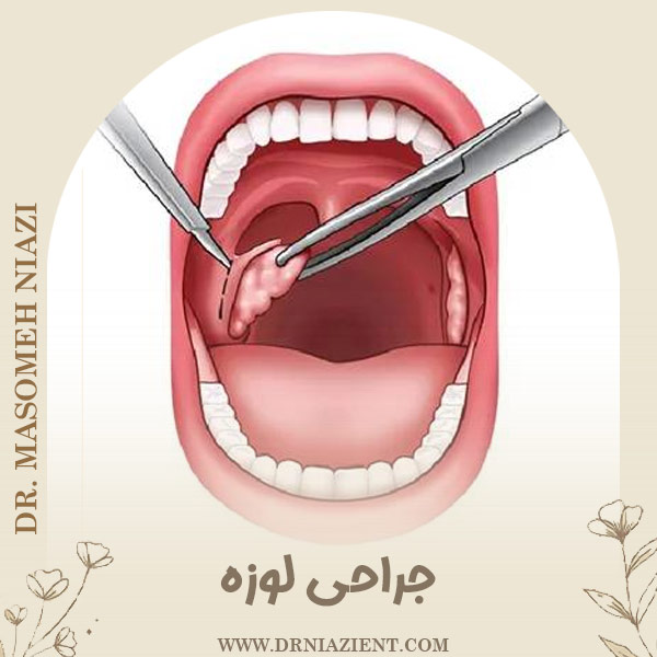 جراحی لوزه - دکتر معصومه نیازی